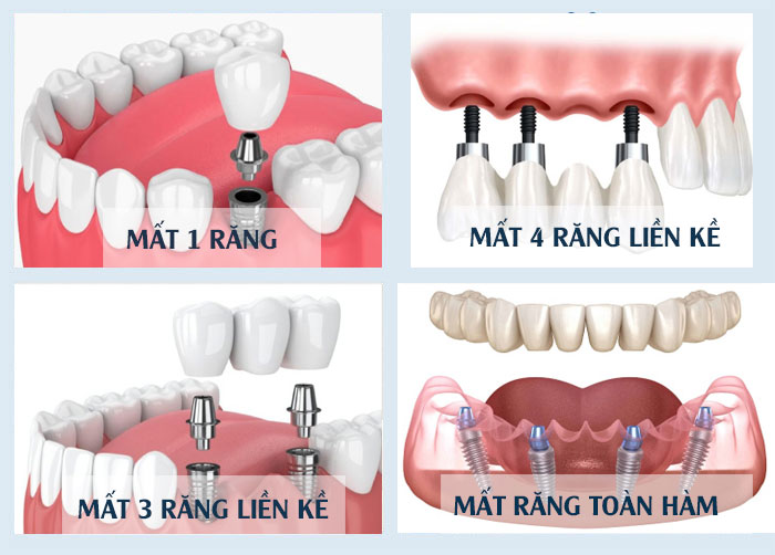 Trồng răng implant là gì? Điều cần biết trước khi cấy implant