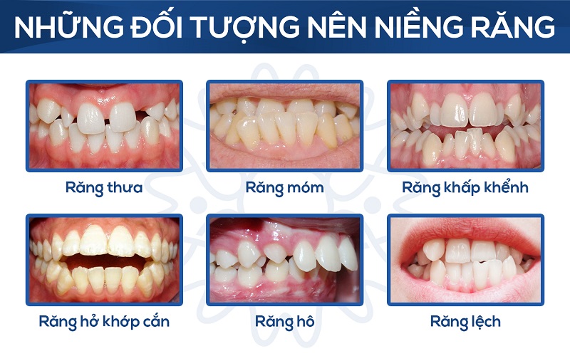 10 vấn đề về niềng răng được nhiều người quan tâm nhất