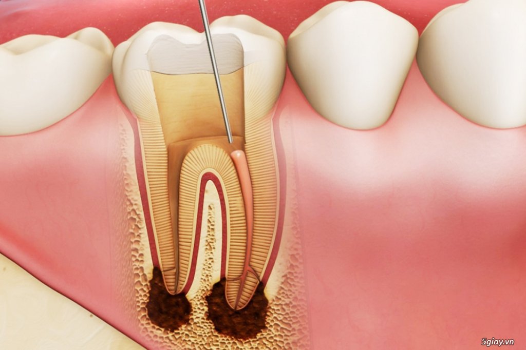 Lấy tủy răng không đau: Những điều cần biết | Vinmec