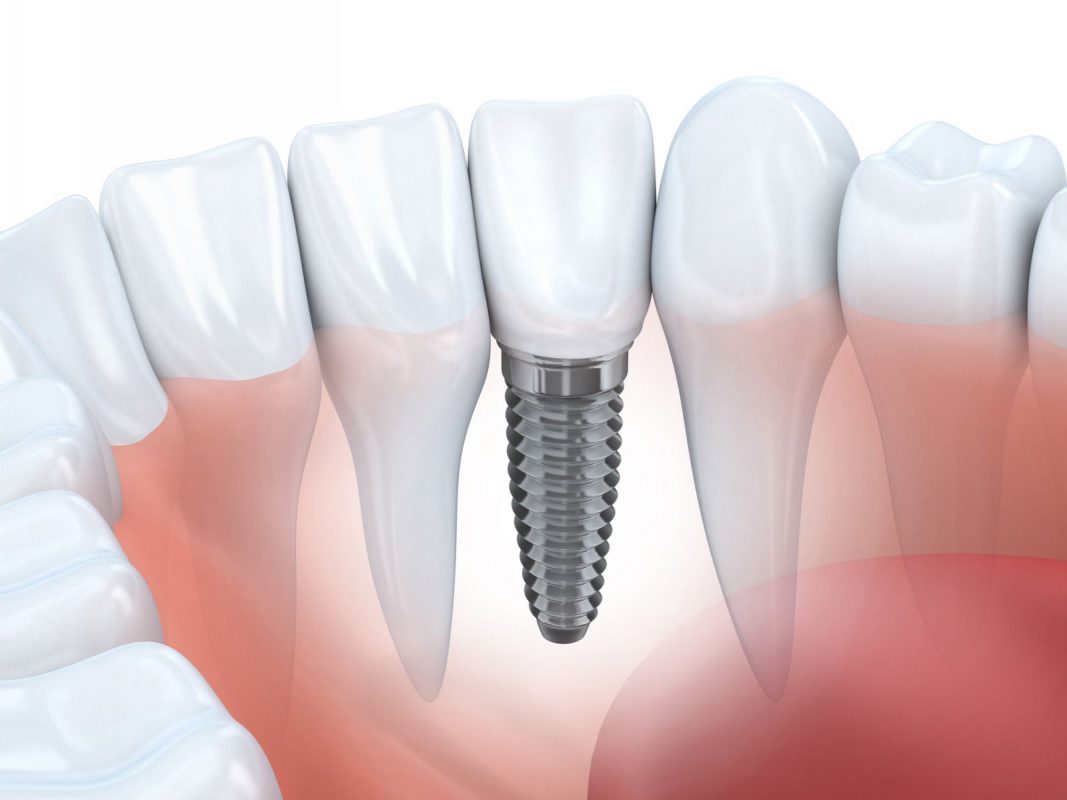 7 nhược điểm của phương pháp trồng răng implant bạn cần nắm rõ -  nhakhoathuyanh