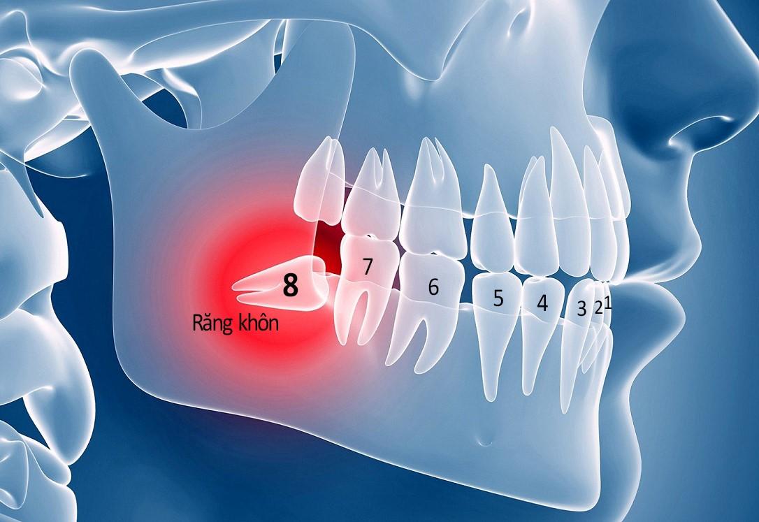 Giải Pháp Nào Cho 4 Răng Khôn Mọc Lệch - Phòng Khám Nha Khoa Thu Trang