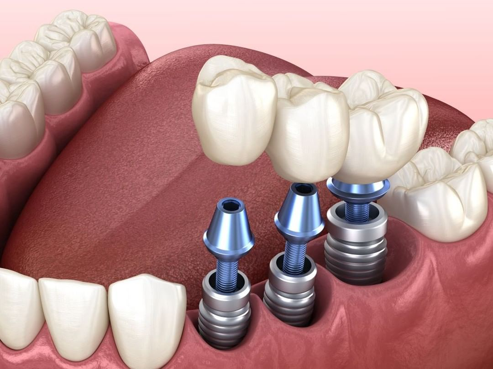 Thời điểm nào tốt nhất để cấy ghép Implant