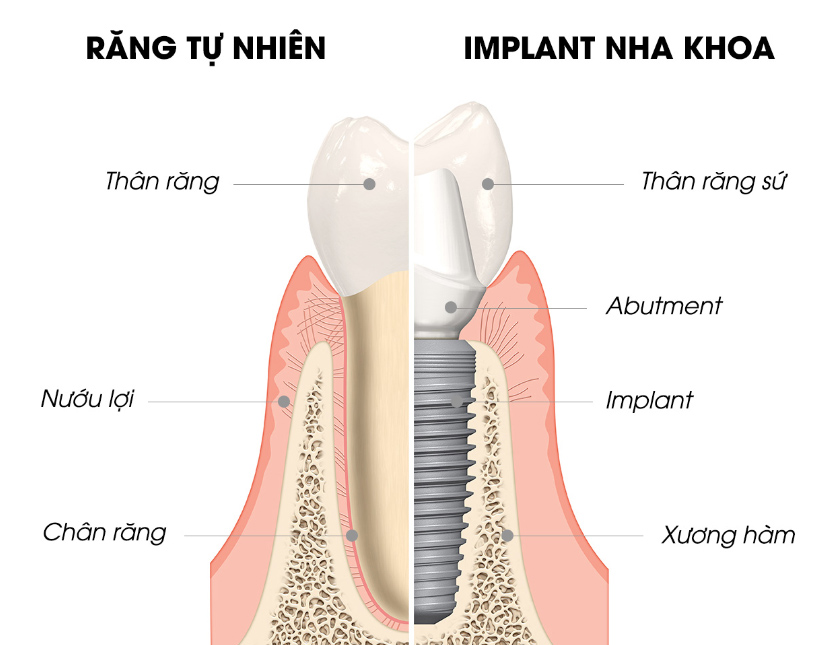 Cấy ghép răng implant tại Nha khoa Tâm Phúc