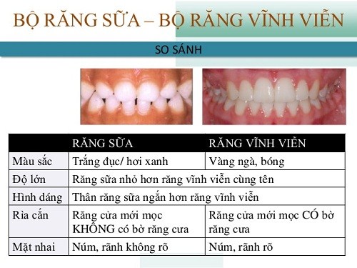 Làm Sao Phân Biệt Được Răng Sữa Và Răng Vĩnh Viễn -4