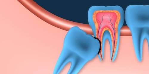 Are People Without Wisdom Teeth Highly Evolved?