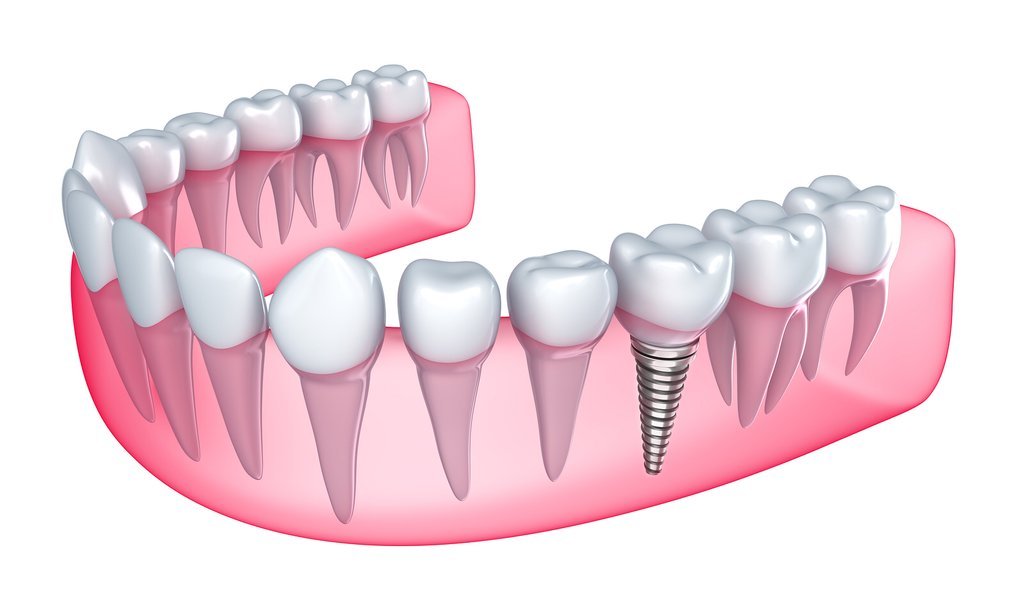 Thời gian sau nhổ răng bao lâu thì có thể cấy implant - nhakhoathuyanh