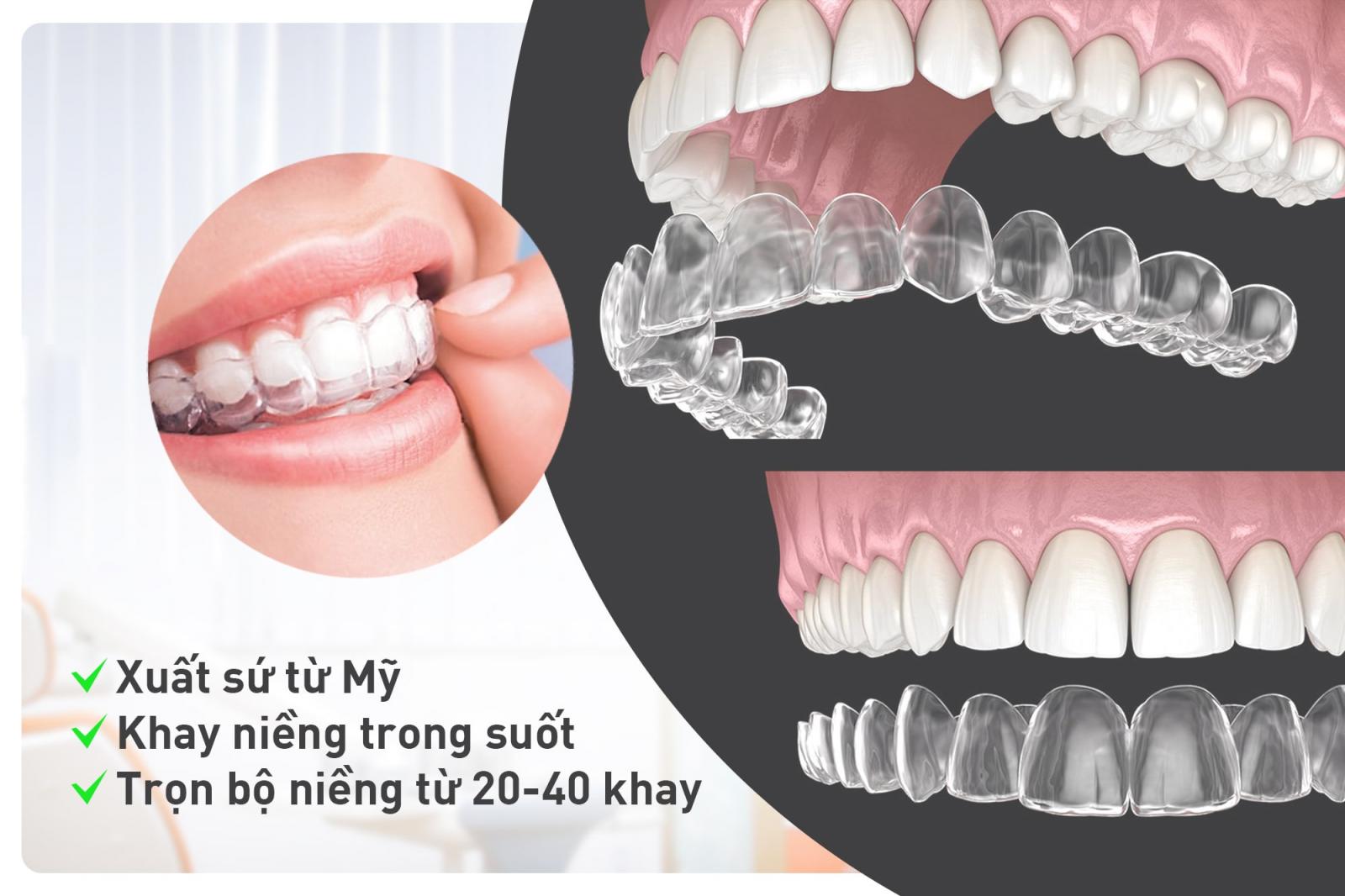 Giá niềng răng Invisalign [tháng 03/2024] tại Up Dental | Up Dental