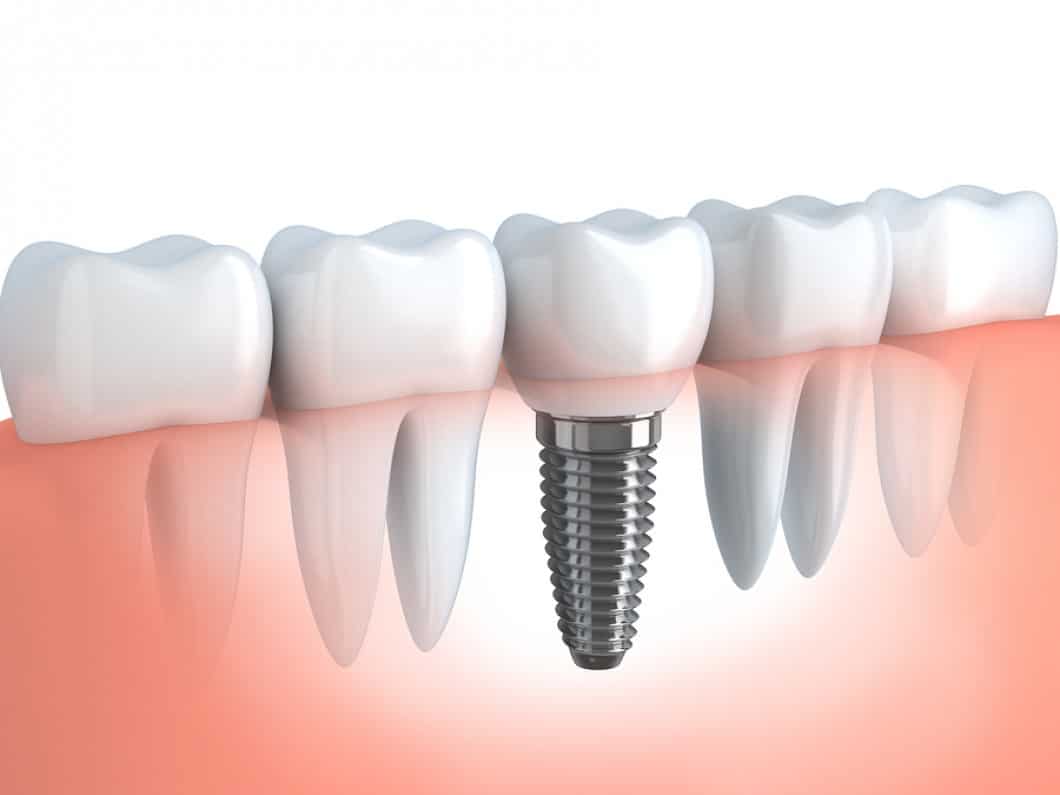 How Much Do Dental Implants Cost? - Dental 359