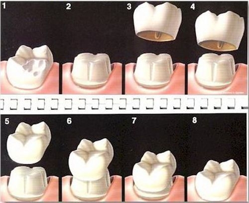 Trồng Răng Sứ Cho Răng Mọc Thưa An Toàn Và Hiệu Quả4