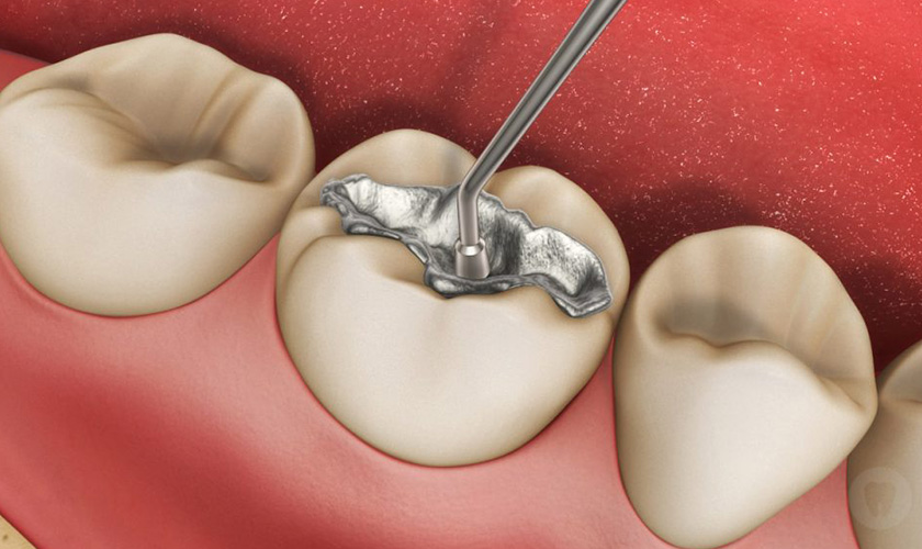 Trám Amalgam là gì? Có tốt không?