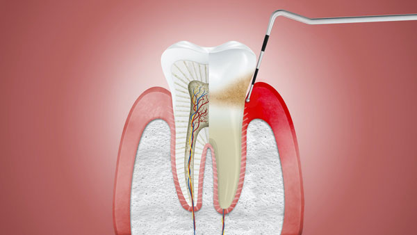 Viêm nướu, viêm lợi là gì? Cách điều trị » Dana Dental