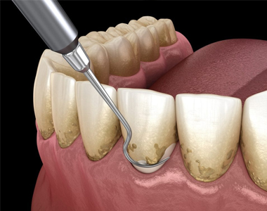 Everything you Need to Know About Scaling and Root Planing -  Charlottesville Dental Associates | Charlottesville Dental Associates