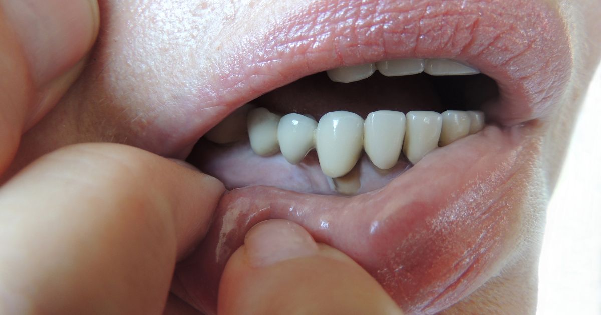 Blog - Artículos De Implantes Dentales - Clínica Ruiz De Gopegui