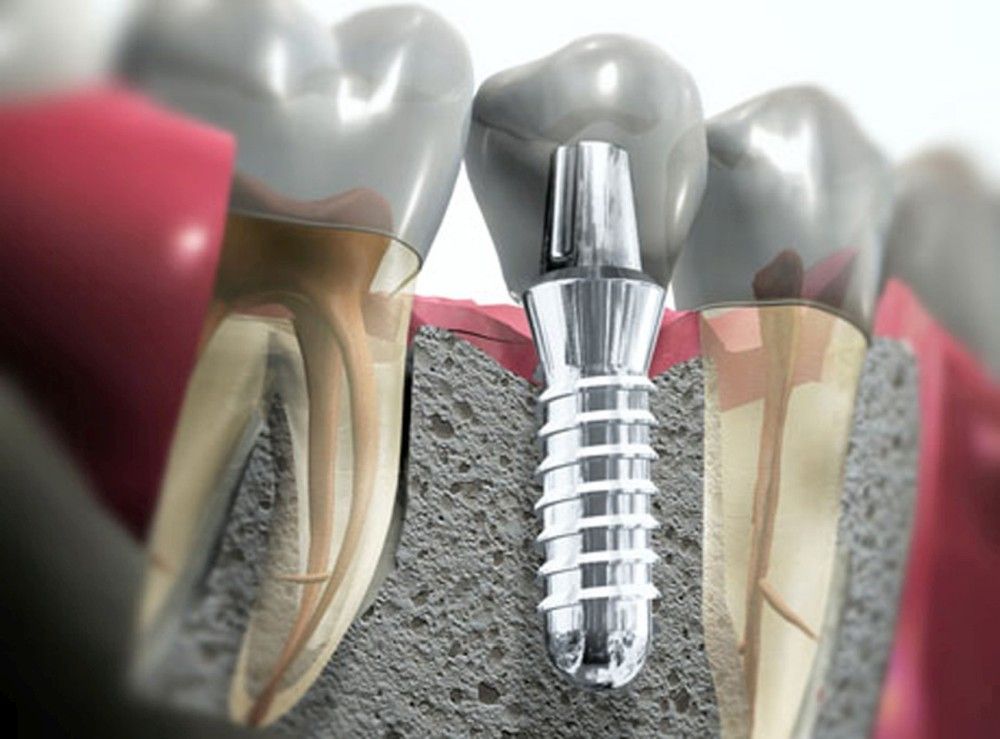 The Basics of Dental Implantology | |