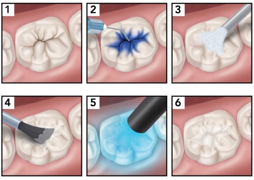 Răng Sâu Lỗ To Có Trám Được Không? - Nha Khoa Đông Nam®