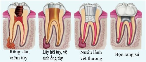 Áp Xe Chân Răng Có Tự Khỏi Không -4