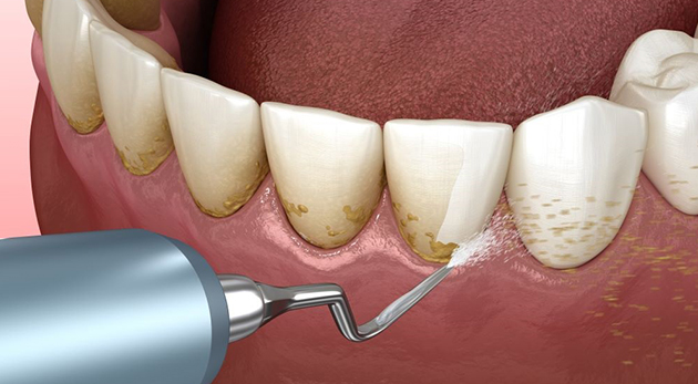 4. Các Lưu Ý Sau Khi Cạo Vôi Răng