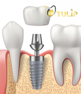 TRỒNG RĂNG IMPLANT