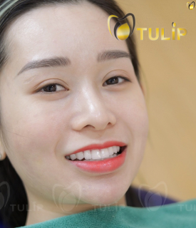 BỌC RĂNG SỨ CAO CẤP LAVA PLUS